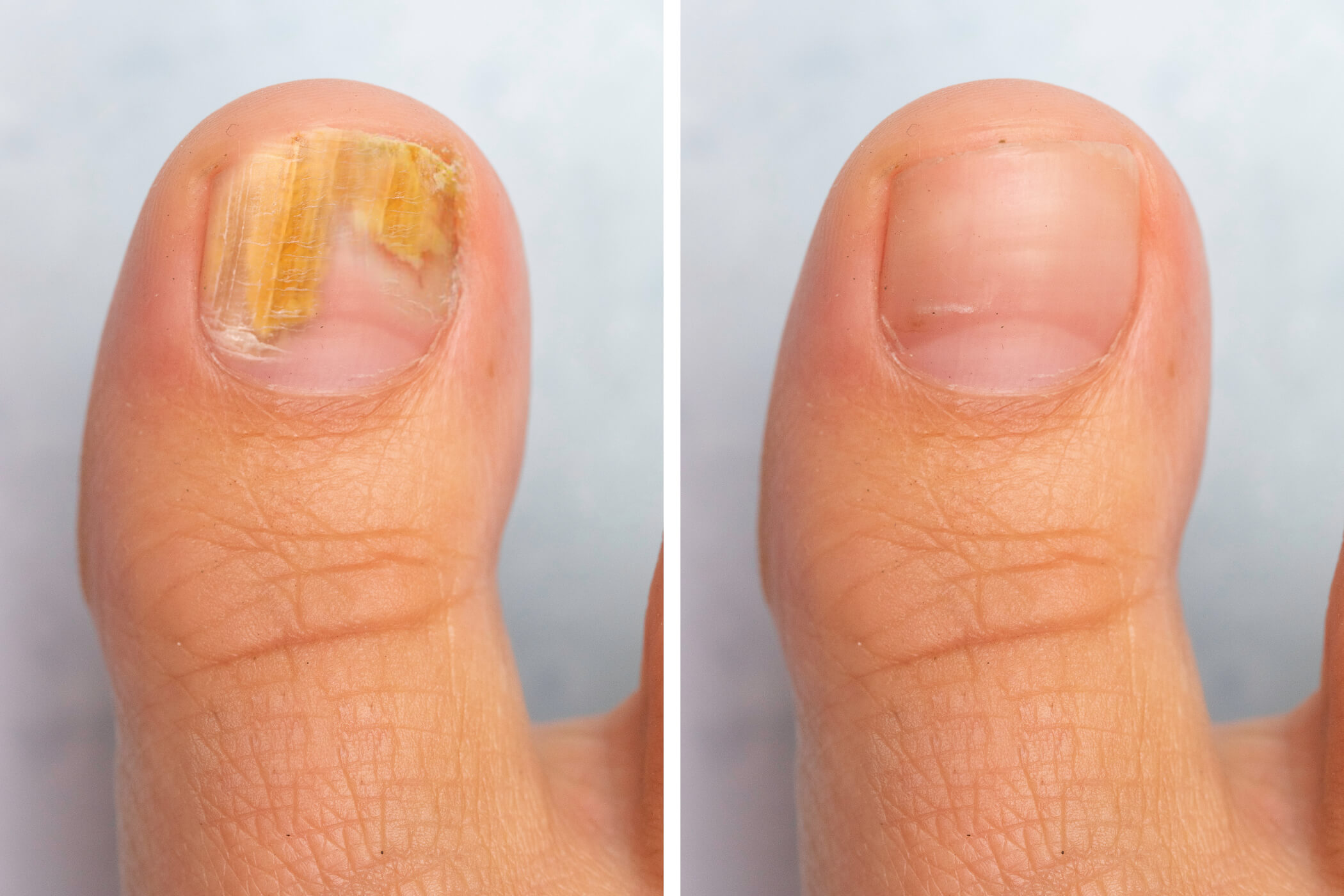 Cure Pain From Toenail Fungus Infection
