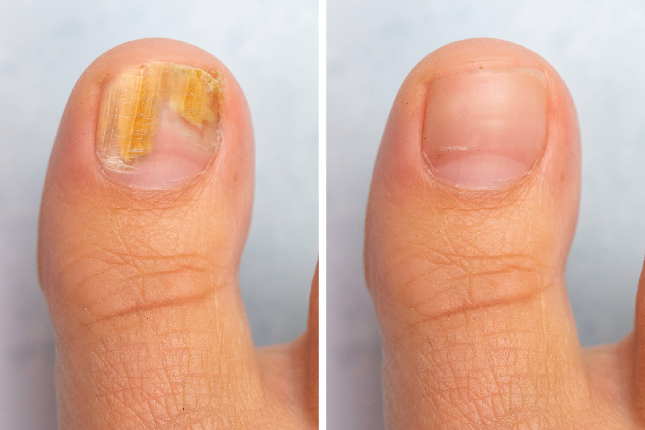 Fungal Nail Infection - MK Feet Podiatry Clinic Fungal Nail Infection - MK Feet Podiatry Clinic